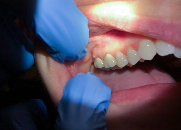 Best Emergency Dentist for Lost Fillings or Crowns in Osceola, IA